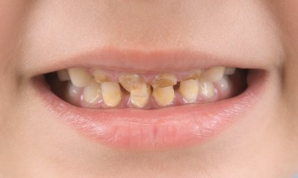 Лечение кариеса у детей